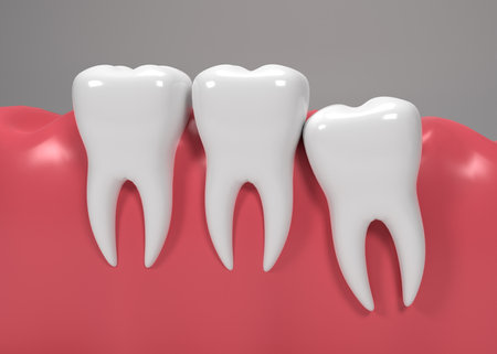 Photo 3d render of teeth with wisdom mesial impactionの写真素材