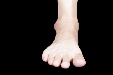 The image of the right foot in front of the astragalus is swollen, matte and black due to inflammation.の写真素材