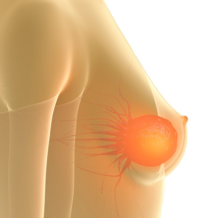 Breast Cancer - 3d rendered illustrationの写真素材
