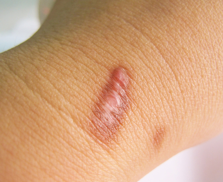 Scar on human burned skin from hot water scald, selective focus