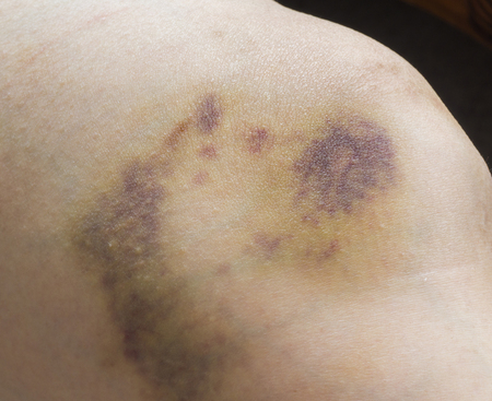 Close up of pain bruises on woman leg