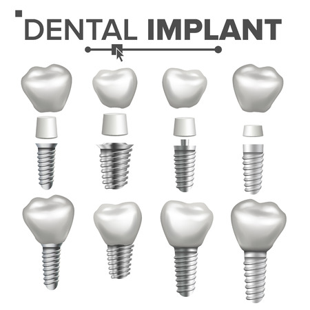 Dental Implant Set Vector. Implant Structure. Crown, Abutment, Screw. Care Stomatology Realistic Isolated Illustrationのイラスト素材
