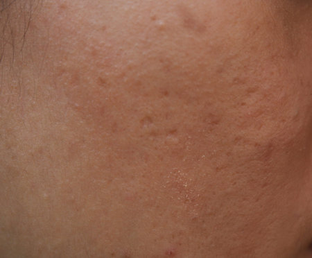 Woman with oily skin and acne scars