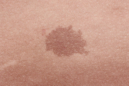Close-up of brown birthmark