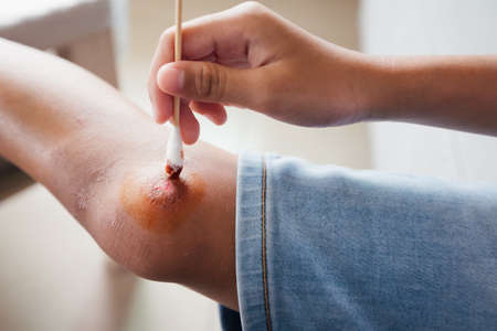 Asian child girl cleaning her wound on her knee injury and perform first aid by herself after she has been an accident.の写真素材