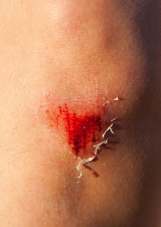 close up of blood on scraped kneeの写真素材