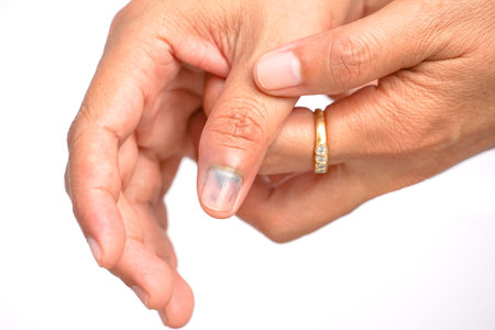 old woman hands holding right hand show bleeding, bruising under a thumb nail that hurt by pressure...