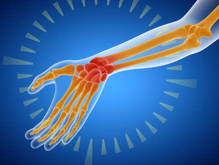The abstract medical exam or research of hand. The sight is aiming for the source of pain represented as red area. The problem is detected. 3d illustration.の写真素材