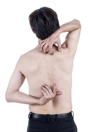 Men with acne rash at the back and neck.の写真素材