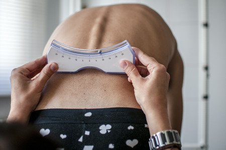 doctor performs a medical examination on a patient diagnosed with scoliosisの写真素材
