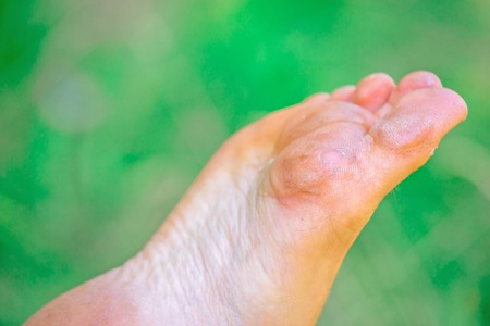 closeup on dry dehydrated skin on the heels of female feet with callusesの写真素材