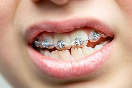 Closeup on teeth with orthodontic brackets. Dental health care.の写真素材