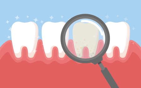Tooth cleaning. Teeth characters before and after whitening. Cartoon tooth before and after cleaning or whitening or dental procedures. Vector, illustration,  flat design, cartoonのイラスト素材