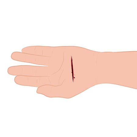 injured hand with bleeding gash with wound on the hand palm vector illustrationのイラスト素材