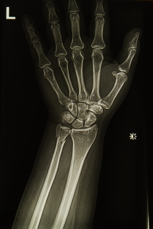 wrist and hand  x-rays imageの写真素材