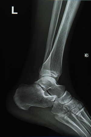 ankle and foot x-rays image lateralの写真素材