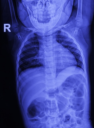 Children chest X-raysの写真素材