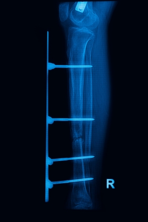 leg x-rays image showing plate and screw external fixation tibia and fibula boneの写真素材
