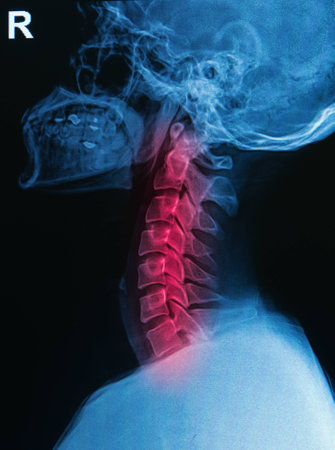 X-ray human skull and spine   cervical spine   show cervical injuryの写真素材
