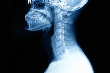 X-ray of  human cervical spine