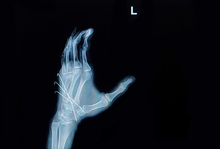 Film x-ray of hand fracture : show fracture metacarpal bone insert with k-wire (Kirschner wire)の写真素材
