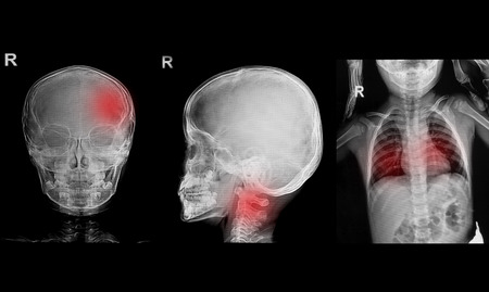 Collection of children x-rays  image show skull and chest image の写真素材