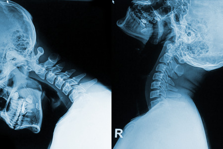 x-ray image of neck show neck pain in flex and exten positionの写真素材