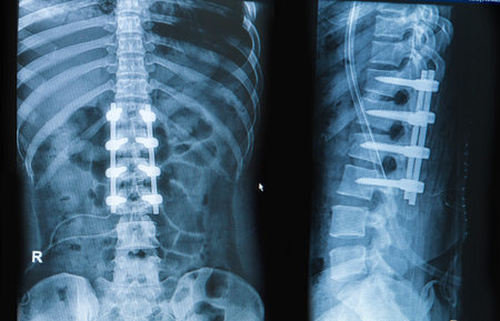 x-ray image of back pain show spinal column with implant, screw placement and fusion
