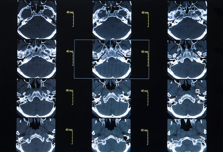 CT Scan Whole Abdomen with contrastの写真素材