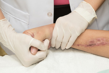 Physical therapist doing hand exercise after injury handの写真素材