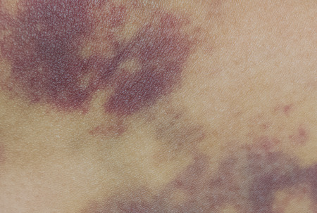 Closeup on a Bruise on wounded woman leg skinの写真素材