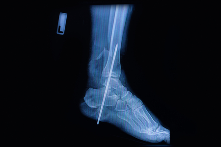 Fracture of the lower part of the fibula, sagital view X-rayの写真素材
