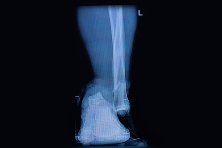 Fracture of the lower part of the fibula, front view X-rayの写真素材
