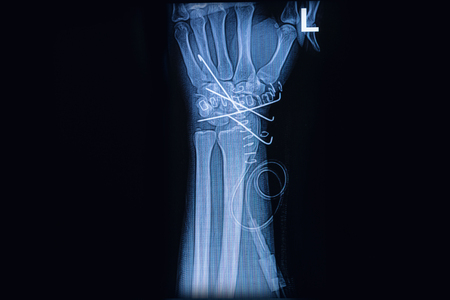 X-ray image of wrist joint, Showing radius fracture with k wire fixationの写真素材