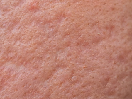 closeup skin problems, nodular cystic acne skin