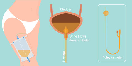 Urinary catheter is a flexible tube used to empty the bladder and collect urine in a drainage bag. Urinary catheters are usually inserted by a doctor, vector illustration.のイラスト素材