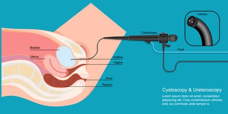 Cystoscopy used to examine urethra and bladder, the doctor passes the tube into the bladder. During...