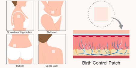 Birth Control Patch is square patch that sticks to the skin.It releases hormones through the skin into the bloodstream to prevent pregnancy.healthcare and medical , vector illustration.のイラスト素材