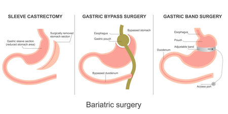 Bariatric surgery isolated on background.Gastric bypass surgery,gastric band surgery,sleeve gastrectomy, medical and healthcare vector illustration.のイラスト素材
