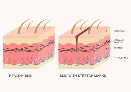 Stretch mark is a type of scar that develops when skin stretches or shrinks quickly. The abrupt change causes the collagen and elastin, which support our skin, to rupture.Medical healthcare, vectorのイラスト素材