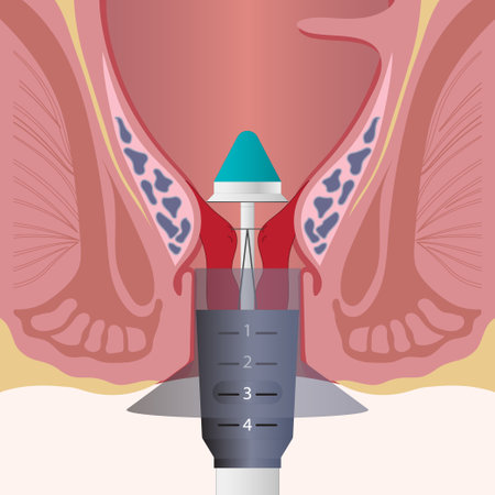 Stapled hemorrhoidopexy is a surgical procedure that involves the cutting and removal of anal hemorrhoidal vascular cushion. Medical instrument health care vector illustration.のイラスト素材