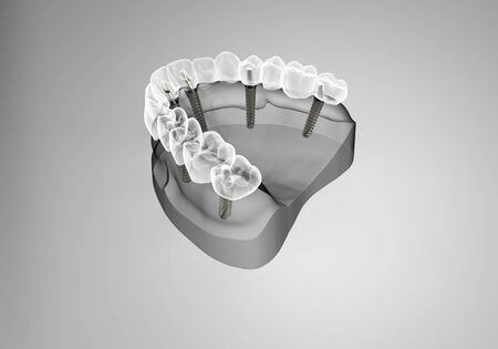3D rendering implant