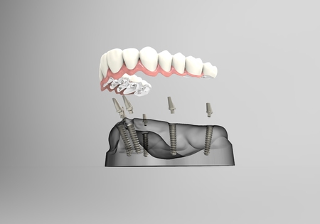 3D rendering implant