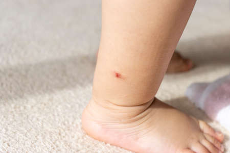 Baby's foot scratched by an insect bite (1 year and 5 months old, girl, Japanese)の写真素材