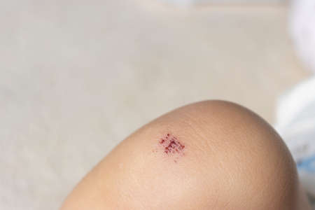 Scratches on baby's knees (1 year and 5 months old, girl, Japanese)の写真素材
