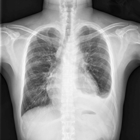 Chest X-ray shows cardiomegaly (enlarged heart) with infiltration and loculated pleural effusion at left hemothoraxの写真素材