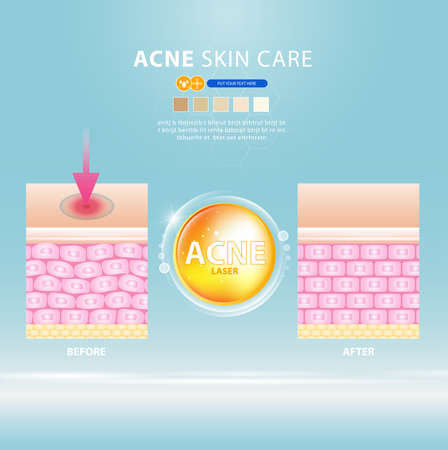 acne skin spot pimple problem vector design.のイラスト素材