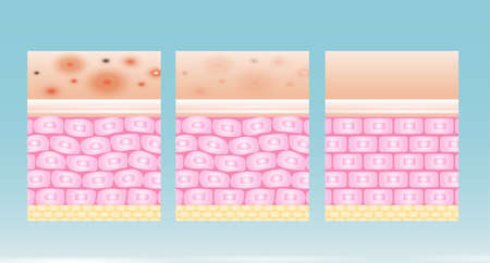 acne skin spot pimple problem vector design.のイラスト素材