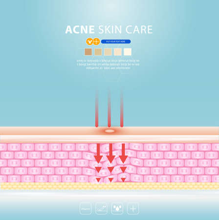 acne skin spot pimple problem vector design.のイラスト素材