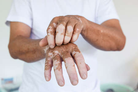 Close-up Vitiligo on skin hands of old people. medical condition causing depigmentation of patches of skin.の写真素材
